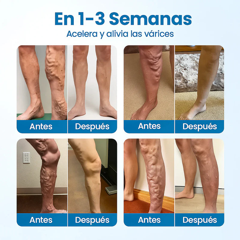 ¡Nuevo! VarixFree® Spray Herbal Plus🌿 - Piernas sin várices en solo 7 días✨